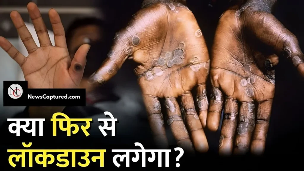 Are there any monkeypox cases in India?